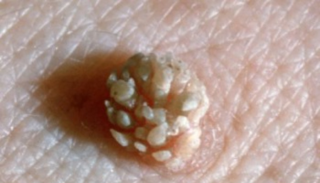 ПЕРИАНАЛЬНЫЕ КОНДИЛОМЫ