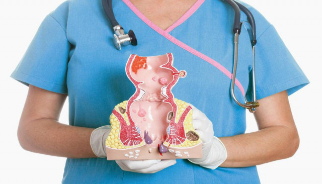 ТРЕЩИНА ПРЯМОЙ КИШКИ